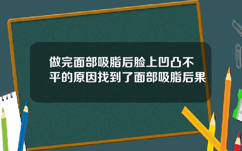 做完面部吸脂后脸上凹凸不平的原因找到了面部吸脂后果