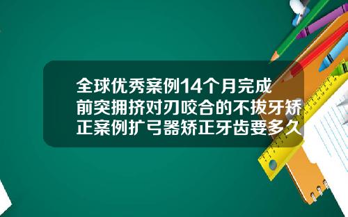 全球优秀案例14个月完成前突拥挤对刃咬合的不拔牙矫正案例扩弓器矫正牙齿要多久