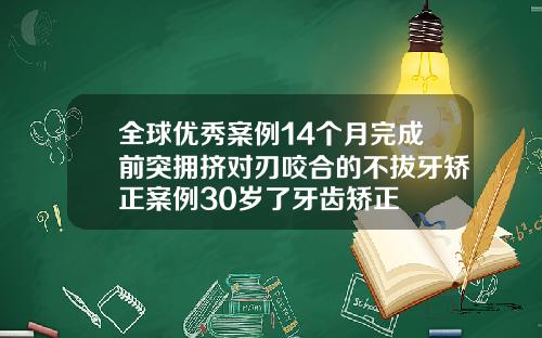 全球优秀案例14个月完成前突拥挤对刃咬合的不拔牙矫正案例30岁了牙齿矫正