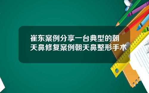 崔东案例分享一台典型的朝天鼻修复案例朝天鼻整形手术