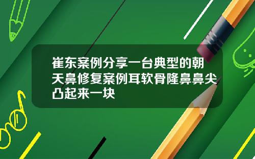 崔东案例分享一台典型的朝天鼻修复案例耳软骨隆鼻鼻尖凸起来一块
