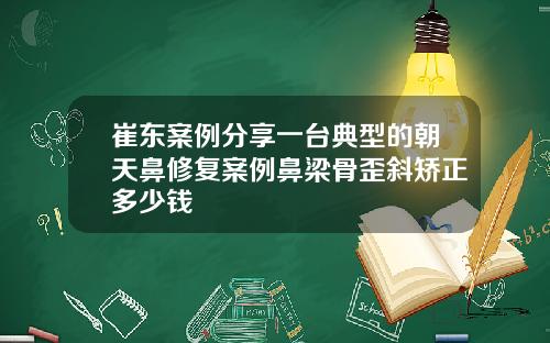 崔东案例分享一台典型的朝天鼻修复案例鼻梁骨歪斜矫正多少钱