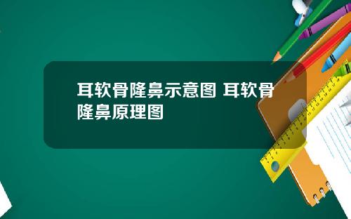 耳软骨隆鼻示意图 耳软骨隆鼻原理图