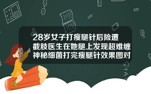 28岁女子打瘦腿针后险遭截肢医生在她腿上发现超难缠神秘细菌打完瘦腿针效果图对比