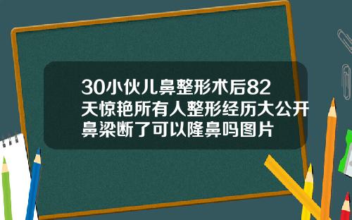 30小伙儿鼻整形术后82天惊艳所有人整形经历大公开鼻梁断了可以隆鼻吗图片