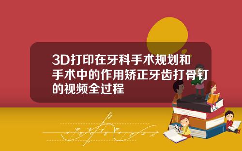3D打印在牙科手术规划和手术中的作用矫正牙齿打骨钉的视频全过程