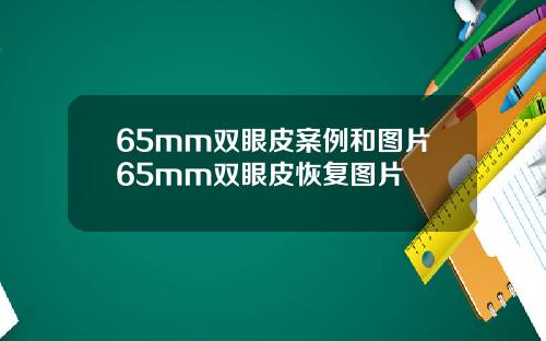 65mm双眼皮案例和图片65mm双眼皮恢复图片